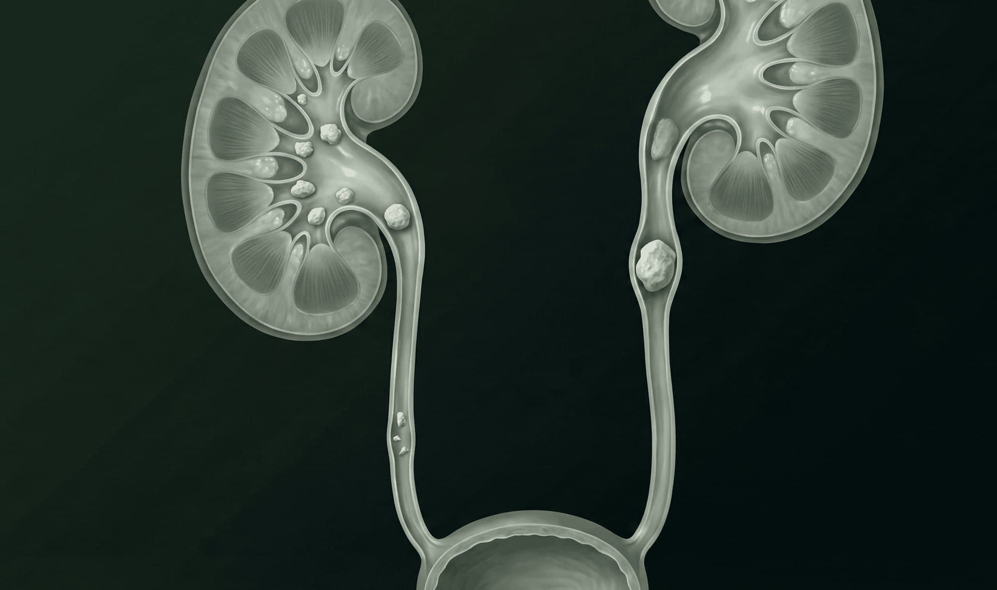 A kidney and ureter drawn as a pale, glass-like illustration on near-black